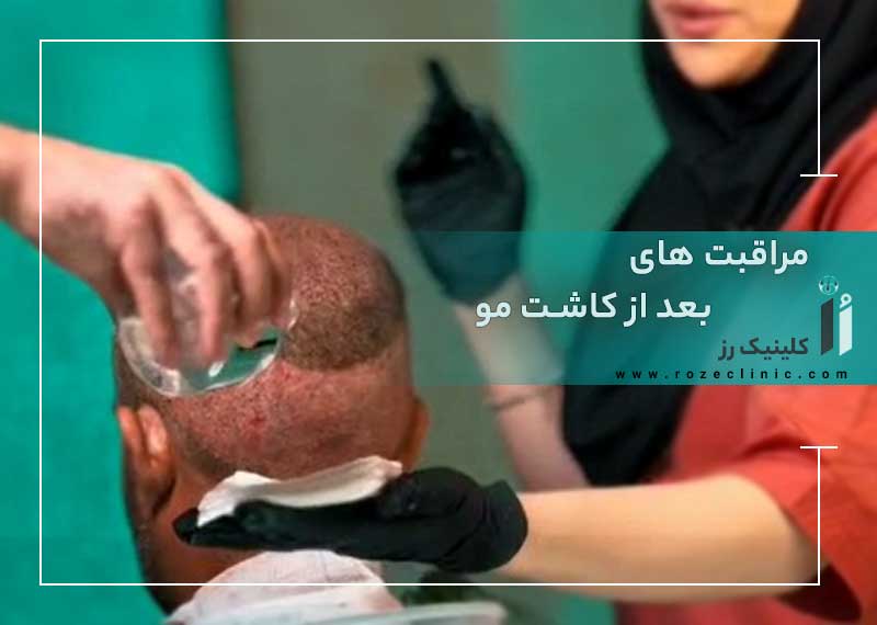 مراقبت های بعد از کاشت مو