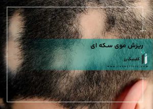 ریزش موی سکه ای