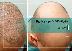 هزینه کاشت مو شیراز