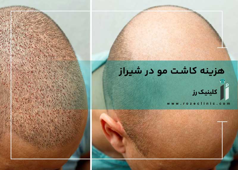 هزینه کاشت مو چگونه محاسبه می‌شود؟