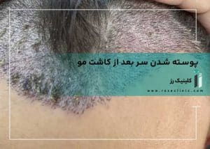 پوسته شدن سر بعد از کاشت مو
