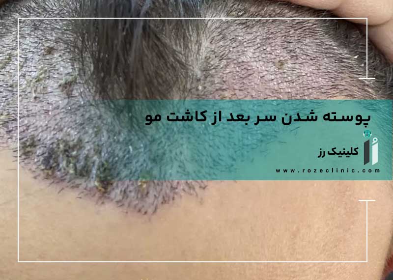 پوسته شدن سر بعد از کاشت مو