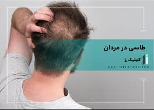 طاسی در مردان