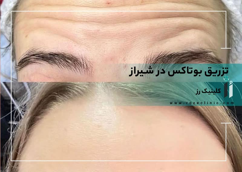تزریق بوتاکس در شیراز