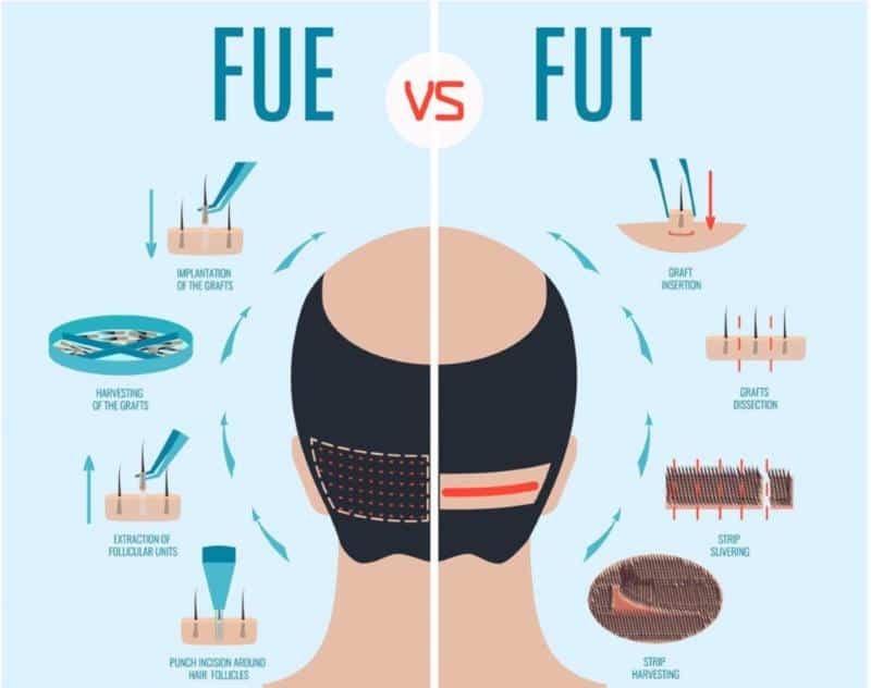 تفاوت FUE با FUT