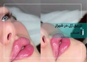تزریق ژل لب در شیراز