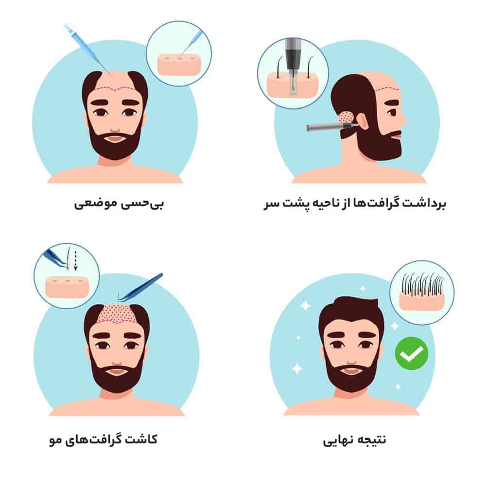 چهار مرحله کاشت مو به روش FUE​