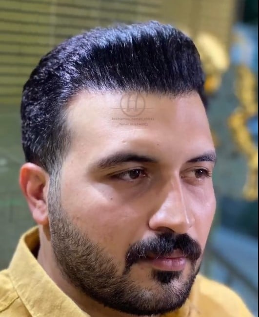 کاشت مو شیراز