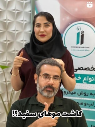 نتیجه کاشت موهای سفید
