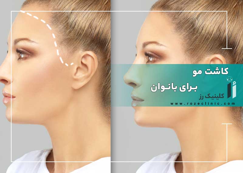 کاشت مو برای زنان
