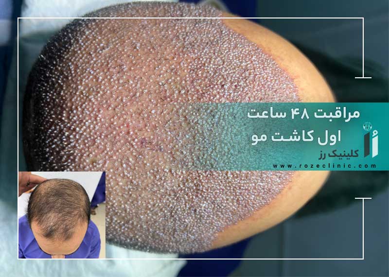 مراقبت ۴۸ ساعت اول کاشت مو (چک‌ لیست شب اول و دوم)