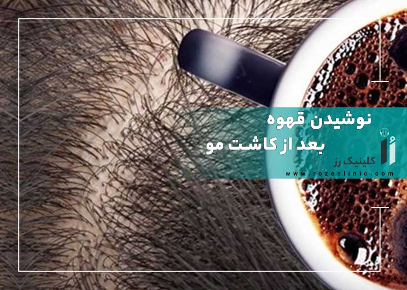 نوشیدن قهوه بعد از کاشت مو