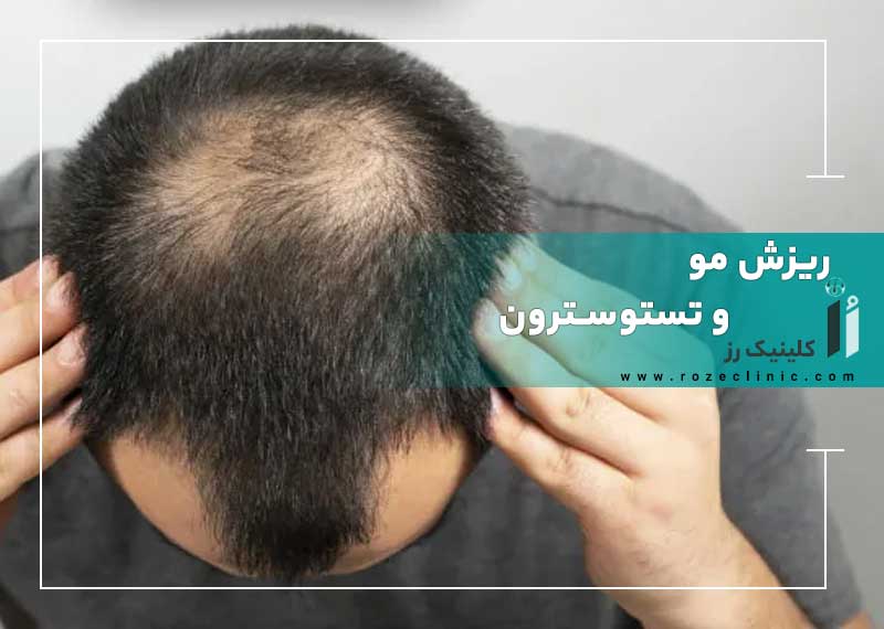 ریزش مو و تستوسترون: واقعیت چیست؟