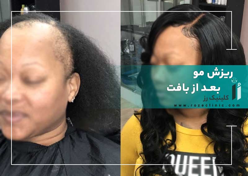 ریزش مو بعد از بافت: چرا اتفاق می افتد و چطور درمان کنیم؟
