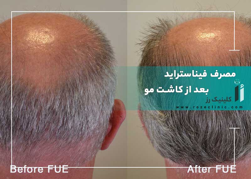 مصرف فیناستراید بعد از کاشت مو