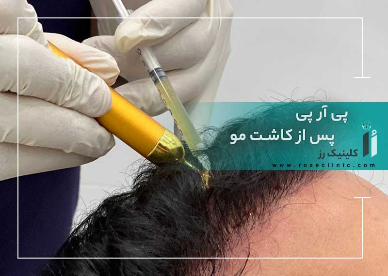 پی‌ آر‌ پی پس از کاشت مو